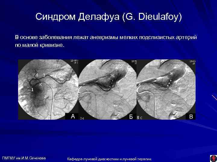 Синдром Делафуа (G. Dieulafoy) В основе заболевания лежат аневризмы мелких подслизистых артерий по малой