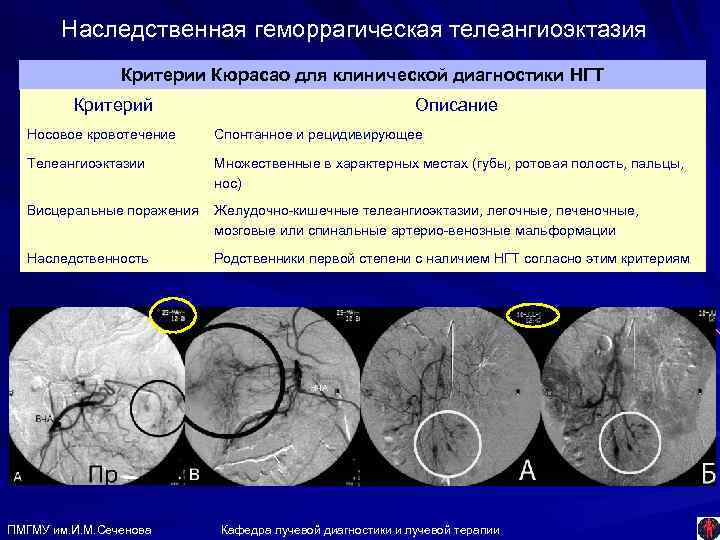 Наследственная геморрагическая телеангиоэктазия Критерии Кюрасао для клинической диагностики НГТ Критерий Описание Носовое кровотечение Спонтанное