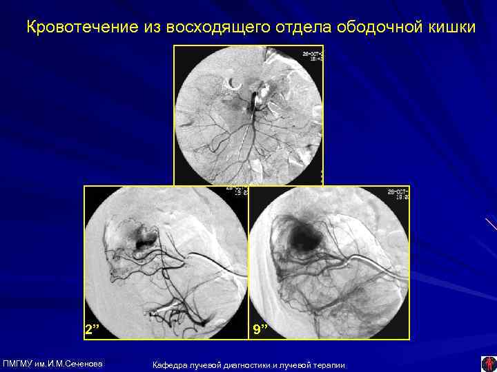 Кровотечение из восходящего отдела ободочной кишки 2” ПМГМУ им. И. М. Сеченова 9” Кафедра