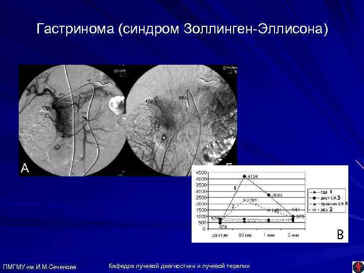 Гастринома (синдром Золлинген-Эллисона) ПМГМУ им. И. М. Сеченова Кафедра лучевой диагностики и лучевой терапии
