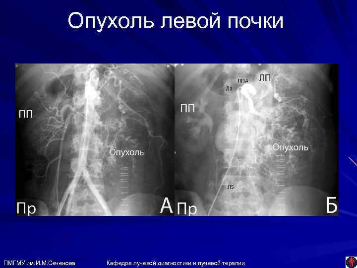 Опухоль левой почки ПМГМУ им. И. М. Сеченова Кафедра лучевой диагностики и лучевой терапии