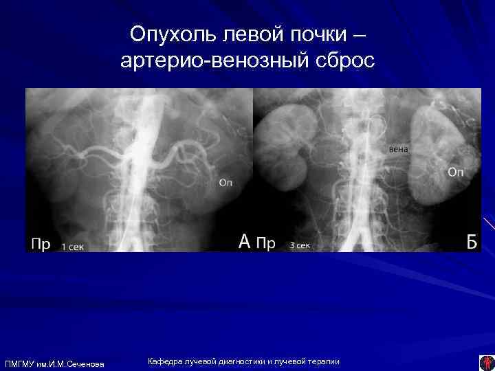 Опухоль левой почки – артерио-венозный сброс ПМГМУ им. И. М. Сеченова Кафедра лучевой диагностики