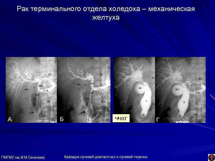 Рак терминального отдела холедоха – механическая желтуха ЧЧХГ ПМГМУ им. И. М. Сеченова Кафедра