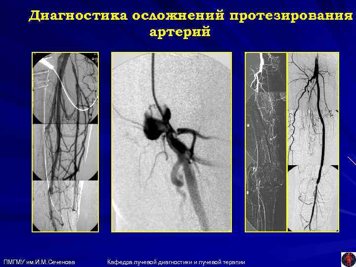 Диагностика осложнений протезирования артерий ПМГМУ им. И. М. Сеченова Кафедра лучевой диагностики и лучевой