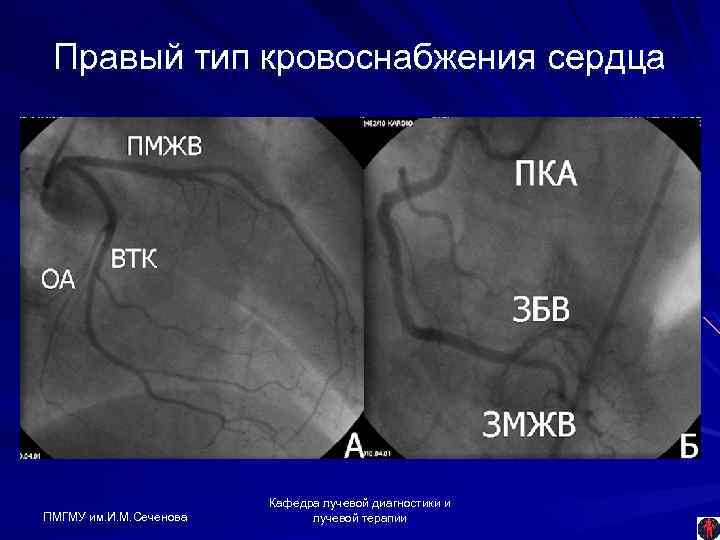 Правый тип кровоснабжения сердца ПМГМУ им. И. М. Сеченова Кафедра лучевой диагностики и лучевой
