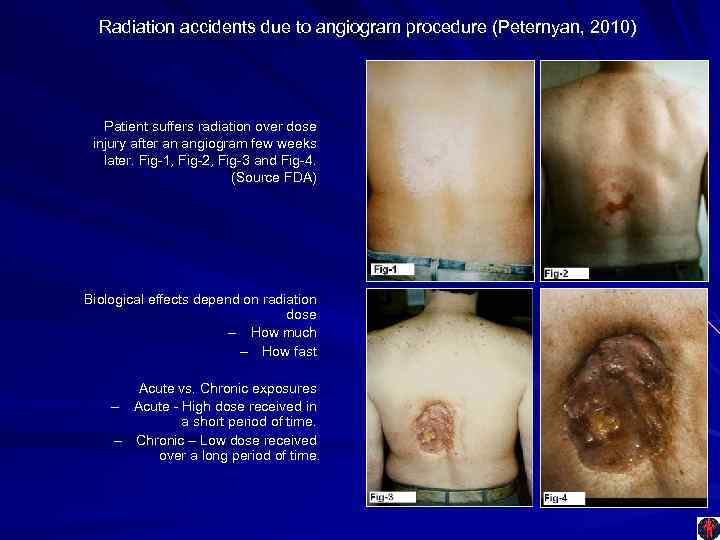 Radiation accidents due to angiogram procedure (Peternyan, 2010) Patient suffers radiation over dose injury