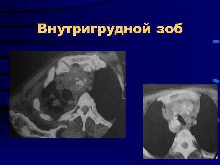 Внутригрудной зоб 