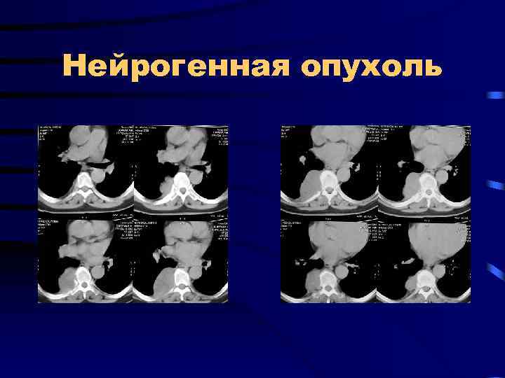 Нейрогенная опухоль 