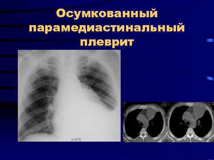 Осумкованный парамедиастинальный плеврит 