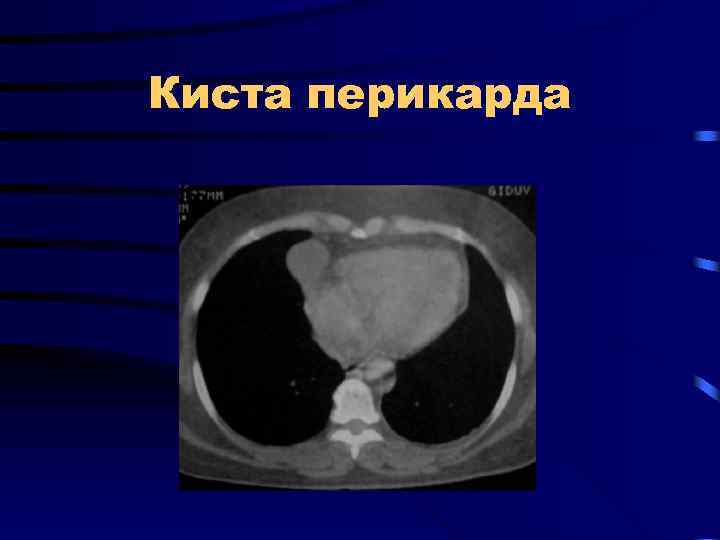 Киста перикарда 