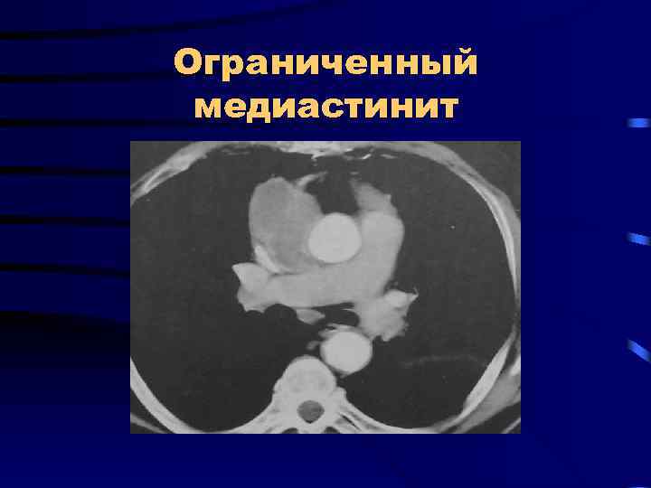 Ограниченный медиастинит 