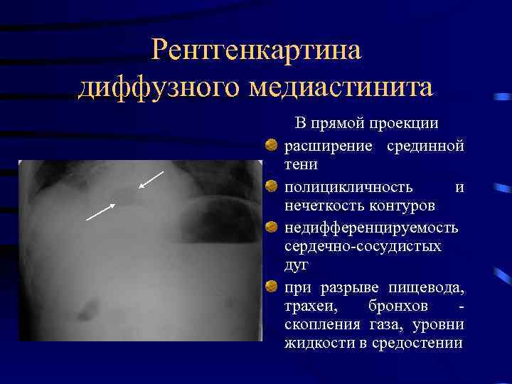 Медиастинит кт картина