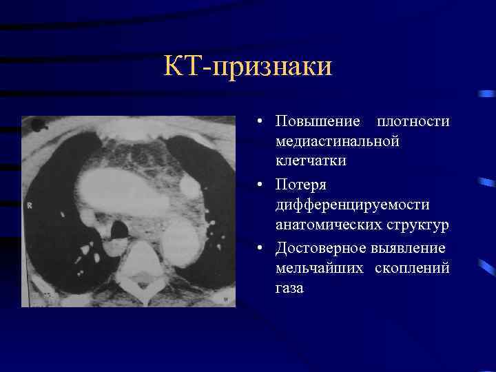 КТ-признаки • Повышение плотности медиастинальной клетчатки • Потеря дифференцируемости анатомических структур • Достоверное выявление