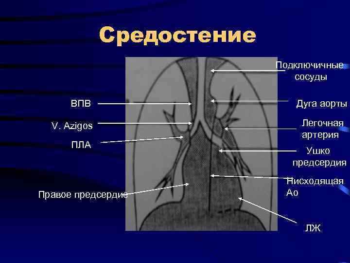 Образования средостения схема