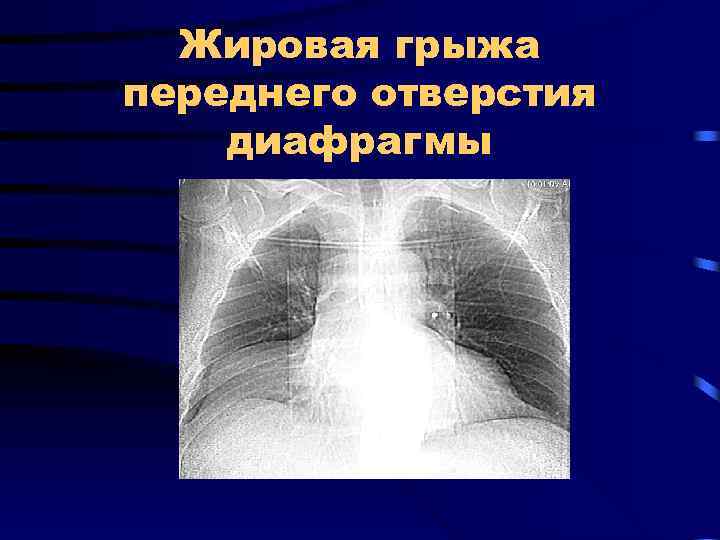 Жировая грыжа переднего отверстия диафрагмы 