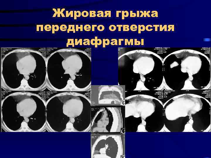 Жировая грыжа переднего отверстия диафрагмы 