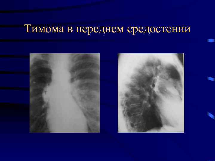 Тимома в переднем средостении 