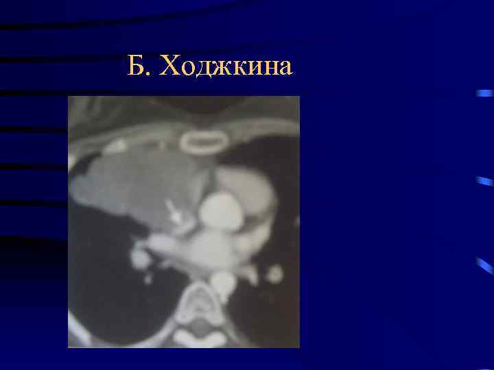 Б. Ходжкина 