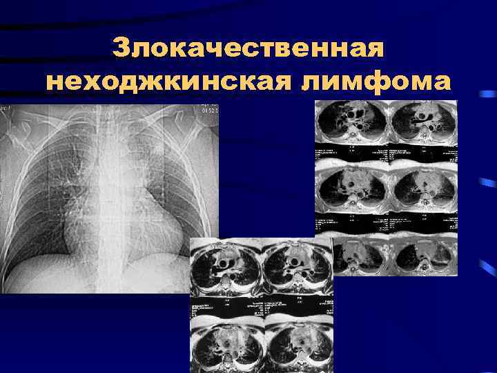 Злокачественная неходжкинская лимфома 