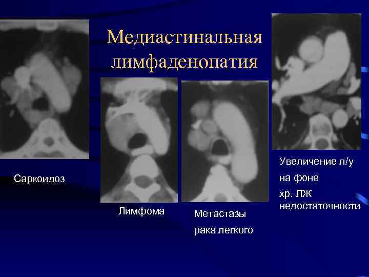 Медиастинальная лимфаденопатия Увеличение л/у на фоне Саркоидоз Лимфома Метастазы рака легкого хр. ЛЖ недостаточности
