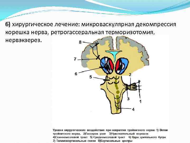 6) хирургическое лечение: микроваскулярная декомпрессия корешка нерва, ретрогассеральная терморизотомия, нервэкзерез. 