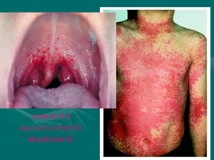 Скарлатина— острое инфекционное заболевание, характеризующеес я общими симптомами интоксикации, ангиной и мелкоточечной экзантемой. 