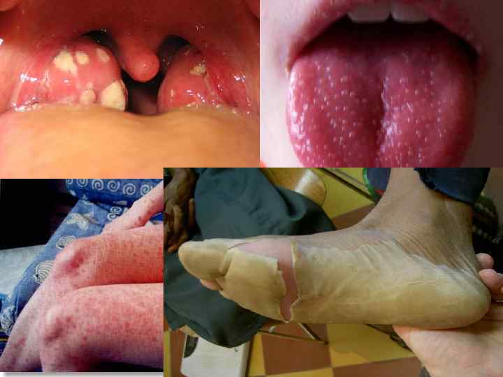 Инкубационный период при скарлатине колеблется от нескольких часов до 7 суток. Начальный период: от