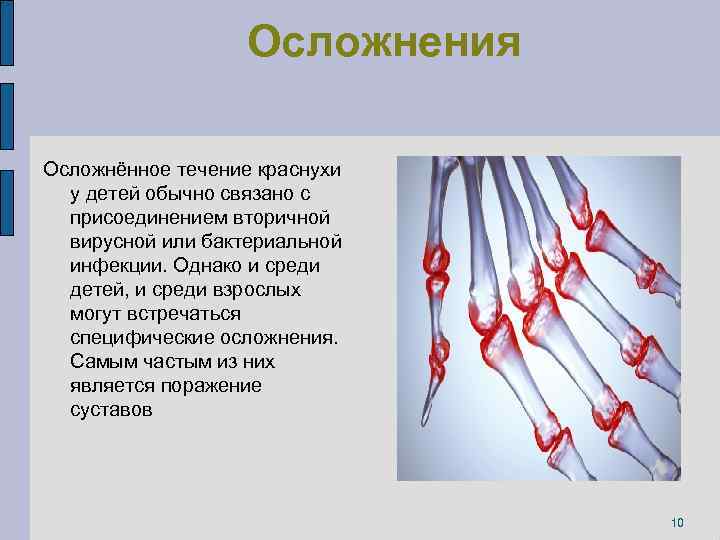 Осложнения Осложнённое течение краснухи у детей обычно связано с присоединением вторичной вирусной или бактериальной