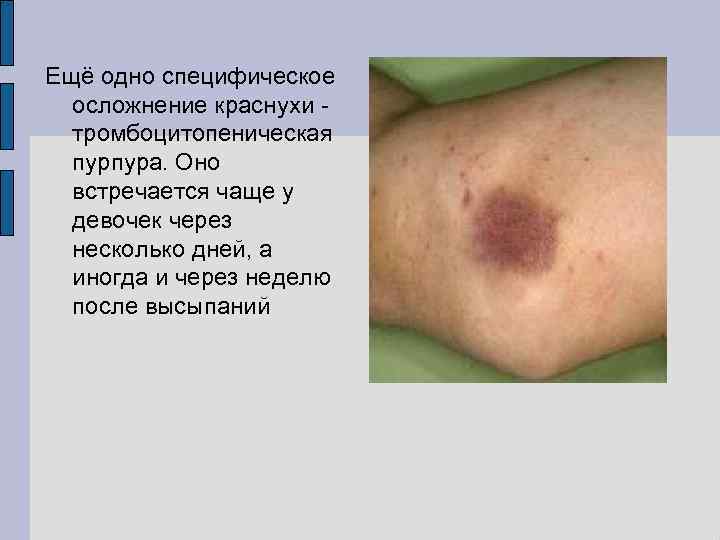 Ещё одно специфическое осложнение краснухи тромбоцитопеническая пурпура. Оно встречается чаще у девочек через несколько
