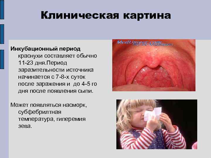 Клиническая картина Инкубационный период краснухи составляет обычно 11 -23 дня. Период заразительности источника начинается