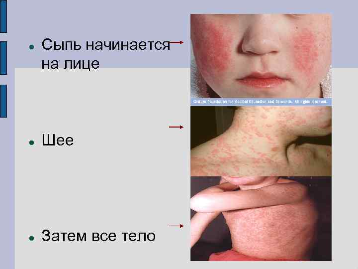  Сыпь начинается на лице Шее Затем все тело 