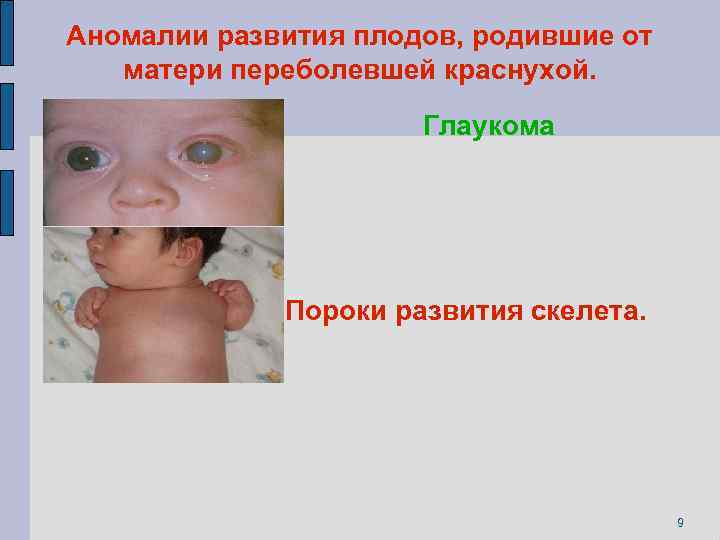 Аномалии развития плодов, родившие от матери переболевшей краснухой. Глаукома Пороки развития скелета. 9 