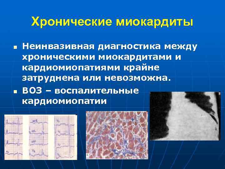 Хронические миокардиты n n Неинвазивная диагностика между хроническими миокардитами и кардиомиопатиями крайне затруднена или