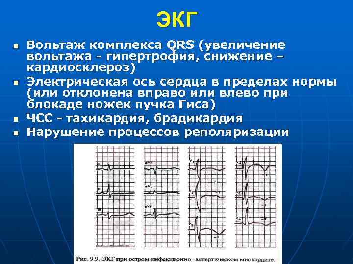 Низкоамплитудные отведения экг