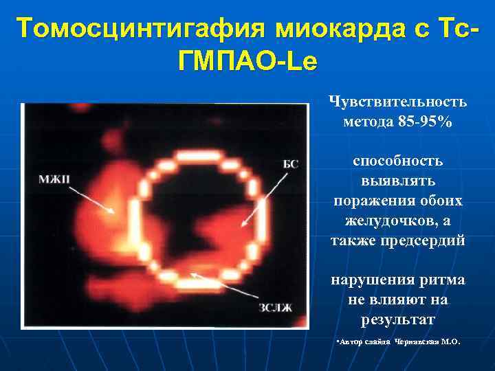 Томосцинтигафия миокарда с Тс. ГМПАО-Le Чувствительность метода 85 -95% способность выявлять поражения обоих желудочков,