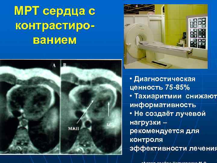 МРТ сердца с контрастированием • Диагностическая ценность 75 -85% • Тахиаритмии снижают информативность •