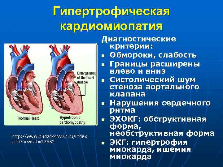 Гипертрофическая кардиомиопатия http: //www. budzdorov 72. ru/index. php? newsid=17552 Диагностические критерии: n Обмороки, слабость