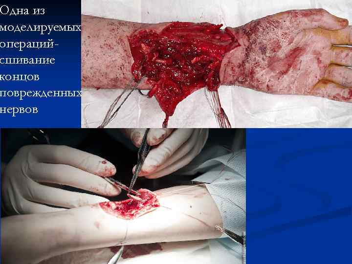 Одна из моделируемых операцийсшивание концов поврежденных нервов 