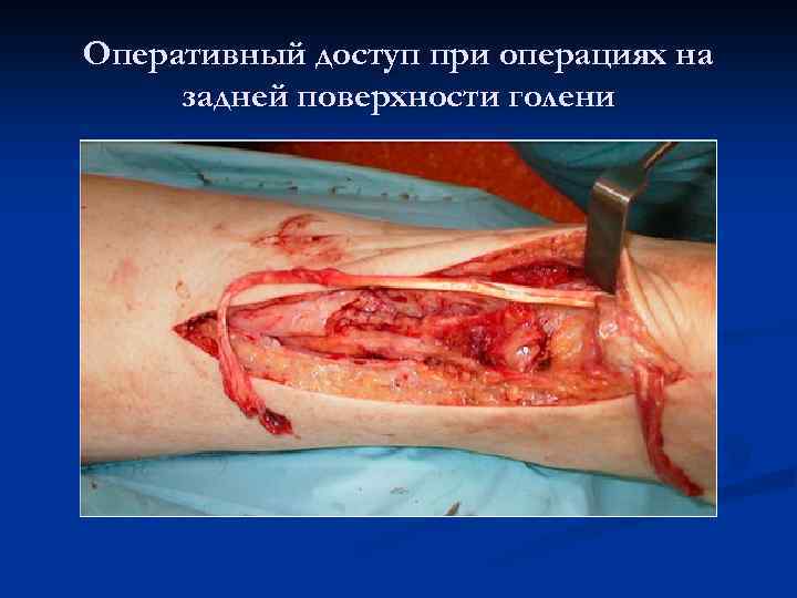 Оперативный доступ при операциях на задней поверхности голени 