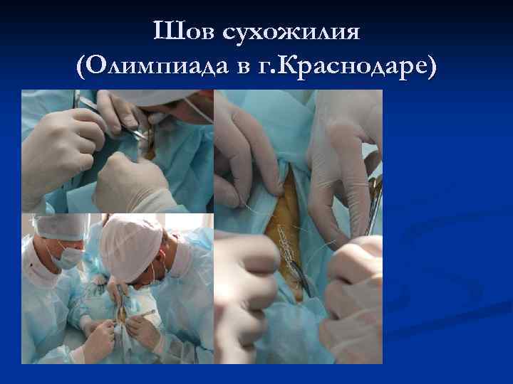 Шов сухожилия (Олимпиада в г. Краснодаре) 