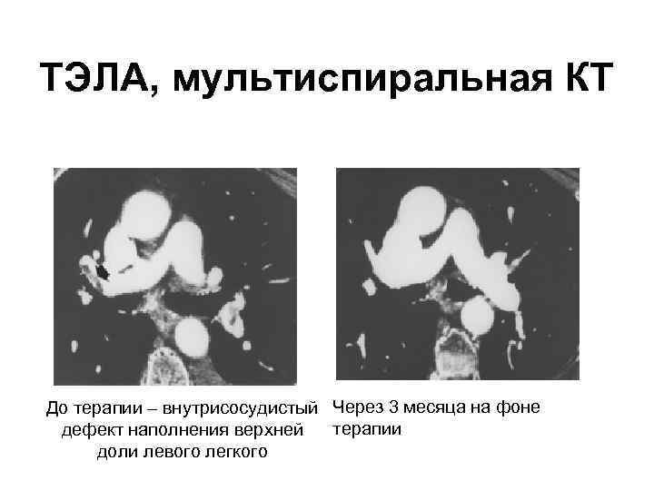 ТЭЛА, мультиспиральная КТ До терапии – внутрисосудистый Через 3 месяца на фоне терапии дефект