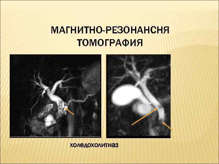 Мрт холангиография. Холедохолитиаз холангиография. Мрт при холедохолитиазе.