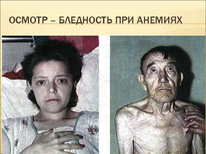 ОСМОТР – БЛЕДНОСТЬ ПРИ АНЕМИЯХ 