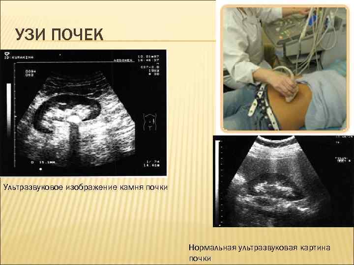 УЗИ ПОЧЕК Ультразвуковое изображение камня почки Нормальная ультразвуковая картина почки 