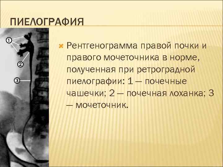 ПИЕЛОГРАФИЯ Рентгенограмма правой почки и правого мочеточника в норме, полученная при ретроградной пиелографии: 1