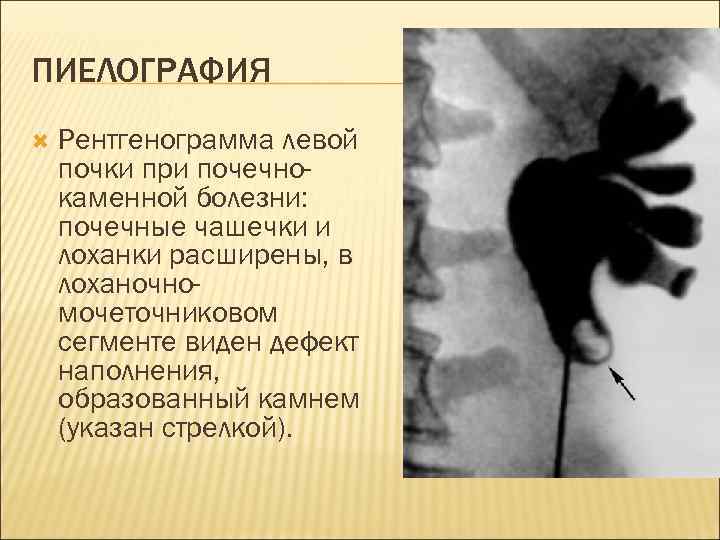 ПИЕЛОГРАФИЯ Рентгенограмма левой почки при почечнокаменной болезни: почечные чашечки и лоханки расширены, в лоханочномочеточниковом