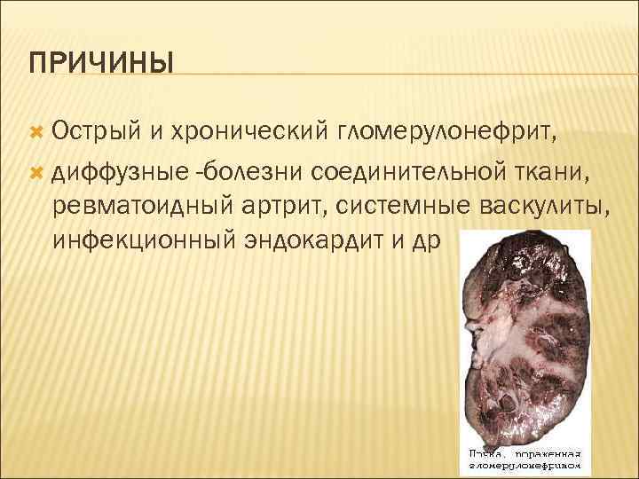 ПРИЧИНЫ Острый и хронический гломерулонефрит, диффузные -болезни соединительной ткани, ревматоидный артрит, системные васкулиты, инфекционный