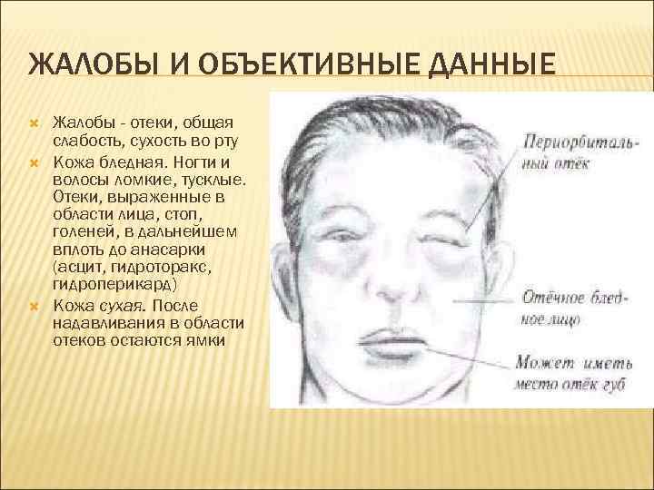 ЖАЛОБЫ И ОБЪЕКТИВНЫЕ ДАННЫЕ Жалобы - отеки, общая слабость, сухость во рту Кожа бледная.