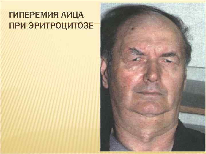 ГИПЕРЕМИЯ ЛИЦА ПРИ ЭРИТРОЦИТОЗЕ 