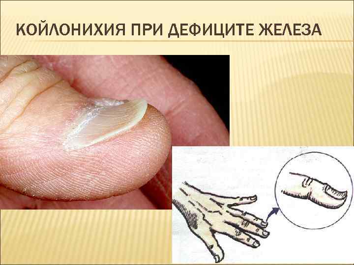 КОЙЛОНИХИЯ ПРИ ДЕФИЦИТЕ ЖЕЛЕЗА 